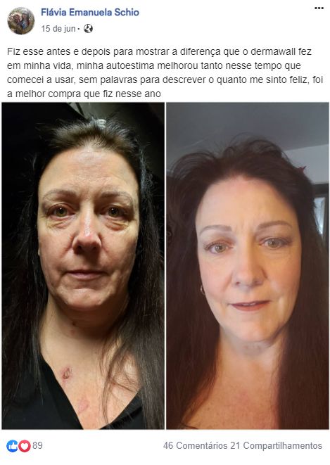 Aparelho de Radiofrequência Reparador de Linhas de Expressão - Derma Wall® + Necessaire Grátis